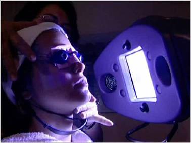 Blue light acne phototherapy