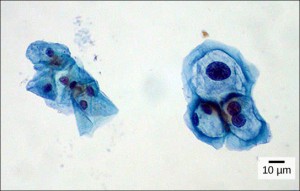 Both normal cells and cells infected with HPV have an irregular, round shape and a well-defined nucleus. The infected cells, however, are two to three times as large as uninfected cells, and some have two nuclei.